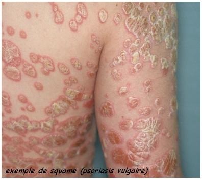 STD Pictures of Symptoms: Herpes HSV 1, Herpes HSV 2 ...