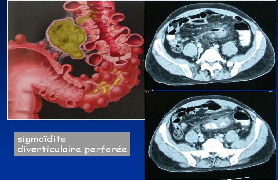 la semiologie de l'imagerie medicale - II.5.5 sigmoidites