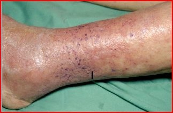 Champori Psoriasis and Eczema Natural Remedies