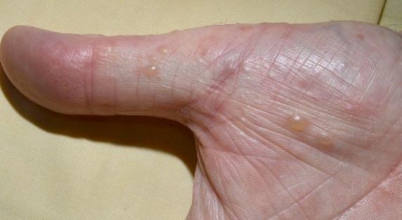 Formes eczema